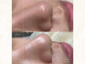 アンド ミヨン(And Miyon)/オリジナル毛穴ケア1回