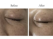 ミナミの雰囲気（微弱電流で目元のクマ・疲れ目にアプローチ。）