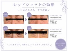 レゾン 京橋店の雰囲気（《最新韓国美容》目元のクマやたるみ取り（眼窩脂肪の分解）に◎）