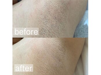 デミーナボーテ(DemynaBeaute)/お試しワキ脱毛★