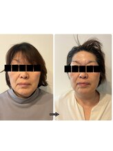 アロラヴィ(AroRavi)/サーマトリックス＆幹細胞導入