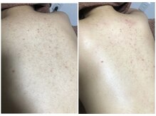 ソレラ(sorelle)/背中脱毛