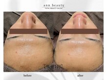 アン ビューティー(ann beauty)/施術1回【症例写真】20代