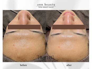 アン ビューティー(ann beauty)/施術1回【症例写真】20代