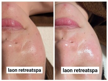 ラオン(laon)/イルミネーティングコース