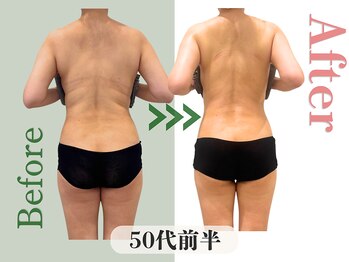 アムール(Amour)/ブラ下のたるみ肉スッキリ！50代