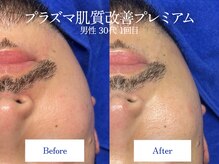 エイトスキン(8skin)/プラズマ/毛穴洗浄/乳酸菌パック