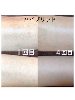 グリン(grin)/ハイブリッド脱毛(2)