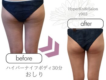 ワイキューマルサン(y903)/ハイパーナイフボディ30分おしり