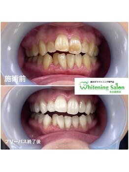 ホワイトニングサロン 名古屋駅店/【ホワイトニング施術例】