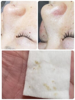 ディオーネ 多治見店(Dione)/【毛穴エクストラクション】