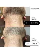 エスト(Est_.)/美容電気脱毛【毛抜き】