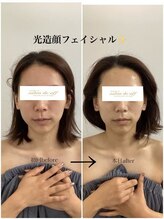 メディカルサロンドオフ 堺東店(medical salon de off)/光造顔フェイシャル★ &nbsp;施術前後