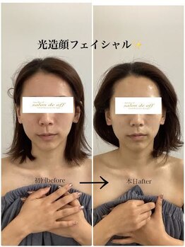 メディカルサロンドオフ 堺東店(medical salon de off)/光造顔フェイシャル★ &nbsp;施術前後