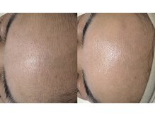 ムゥ(Mwoo)/フェイシャルワックス/顔脱毛