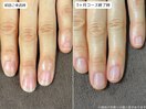 自爪育成・深爪・川崎