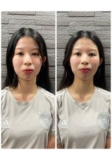 長寿鍼灸院 長寿整骨院/美容鍼50本の効果★ハリ・ツヤ