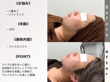 ルディラ 池袋店/マイクロリフト