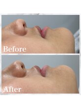 スカイカット(SKY CUT)/気になる鼻の下の産毛…