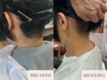 クラームビューティー(Clerm beauty)/美容師によるうなじデザイン脱毛