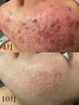 【ニキビ・凹凸ケア】 ハーブピーリング+韓国肌管理O2toDerm