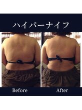 ハリルル 併設 GLケンタ鍼灸整骨院(HARILULU)/むくみを取る！ハイパーナイフ