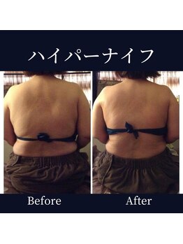 ハリルル 併設 GLケンタ鍼灸整骨院(HARILULU)/むくみを取る！ハイパーナイフ