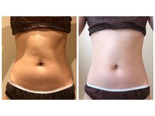 エイシスグロウ(asis glow.)/効果写真