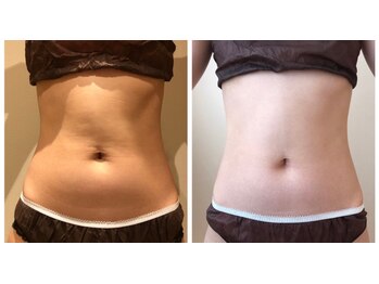 エイシスグロウ(asis glow.)/効果写真