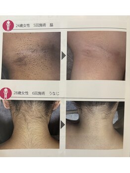 アロラヴィ(AroRavi)/結果重視のハイブリッド脱毛