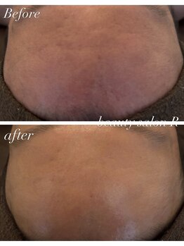 ビューティサロン アール(R)/おでこのお肌トラブルも改善