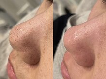 ベイビースキンファクトリー(BABY SKIN FACTORY)/鼻の黒ずみ、お任せください！