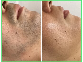 クリア 尾張旭店(Clear)/【Clear脱毛ビフォーアフター】