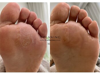 ロンディネ(Rondine)/足裏角質ケア