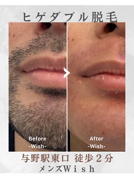 メンズ脱毛 ウィッシュ(Wish)の写真/《清潔感UPで第一印象◎メンズWヒゲ脱毛》ワックス×光のダブルで青ヒゲ対策!!洗顔&美白導入付¥13000/初回
