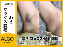 アルゴ 豊中岡町駅前店(ALGO)/【アルゴ式WAX脱毛+光脱毛】