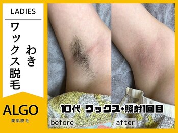 アルゴ 豊中岡町駅前店(ALGO)/【アルゴ式WAX脱毛+光脱毛】