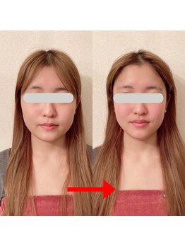 グロッシー(glossy)/小顔矯正