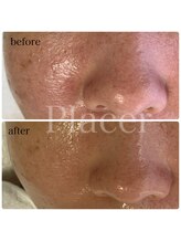 プラセル(Placer)/赤み、テカリもご相談ください