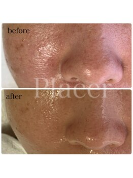 プラセル(Placer)/赤み、テカリもご相談ください