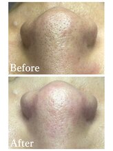 ジェンヌ(jenne.)/毛穴エクストラクション