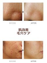 カピリナスパ(Ka.Pilina Spa) 肌改善 毛穴ケア
