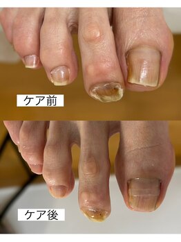 おん/爪ケア症例2025.4.1