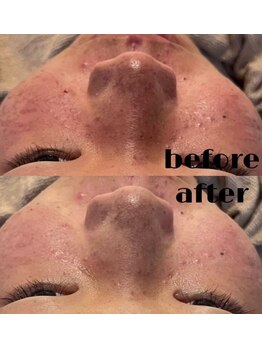 #美容革命ラボ 大阪南堀江店/毛穴洗浄・リブセラ/梅田難波