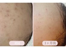 エピル(EPIL)/スキンケアセット症例