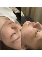 #美容革命ラボ 福岡春吉店/肌改善【天神春吉】