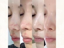 アンド ミヨン(And Miyon)/マッサージピール1回1週間の経過