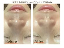 ブプラ 小倉店(BUPURA)/毛穴ごっそり洗浄！