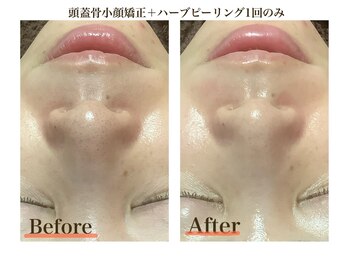 ブプラ 小倉店(BUPURA)/毛穴ごっそり洗浄!