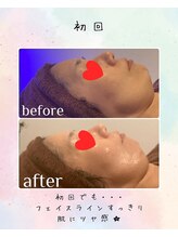 リリアン(lirien)/毛穴/毛穴ケア/毛穴洗浄/駒込